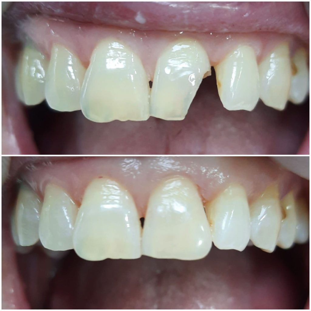 veneers fiaclaireachd