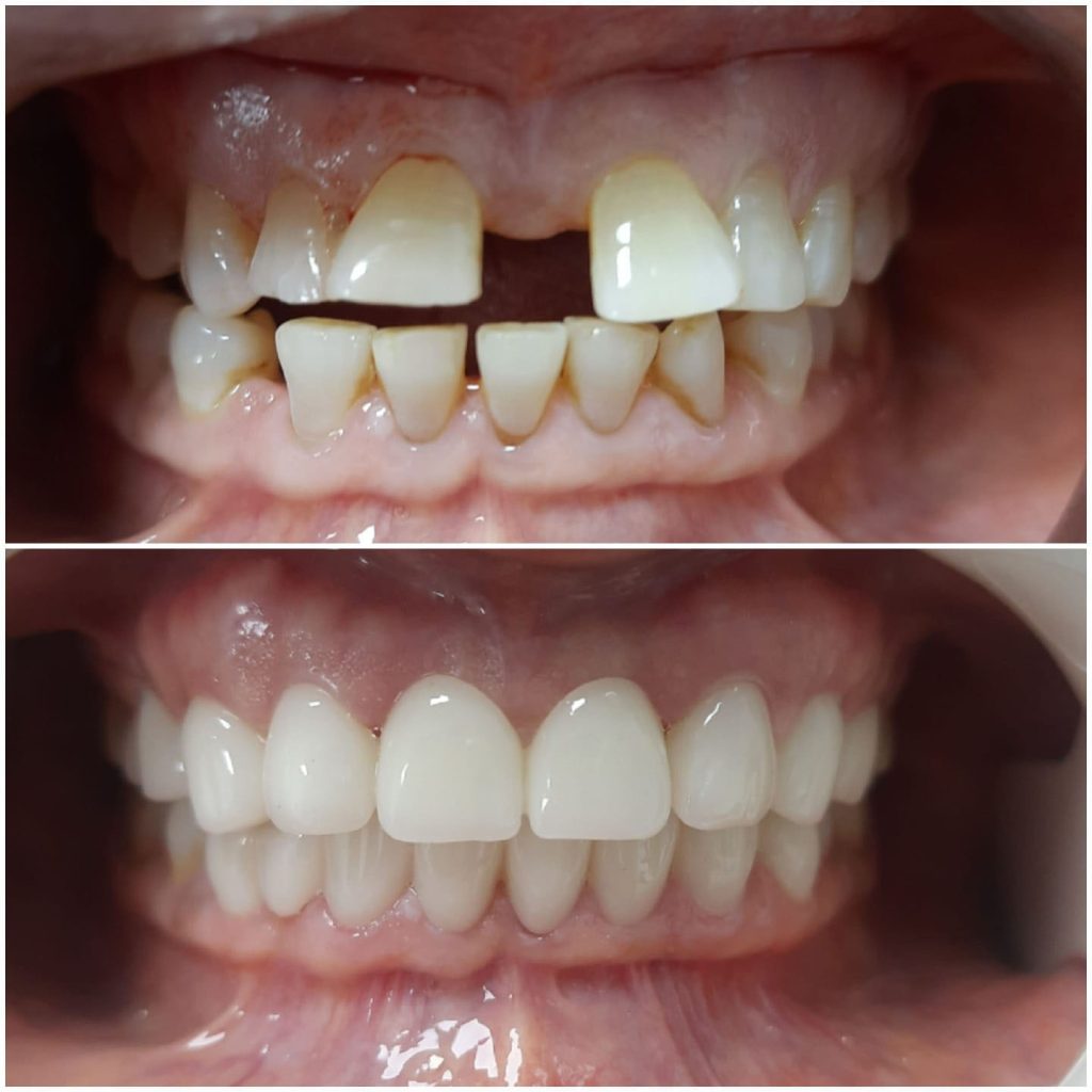 Which Country is the Best for Dental Work? 2 Dental Work