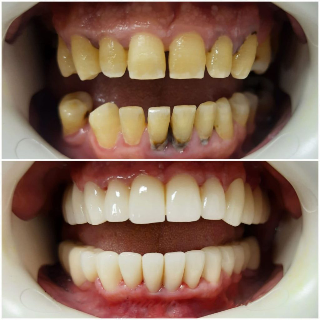 Alanya Teeth Whitening