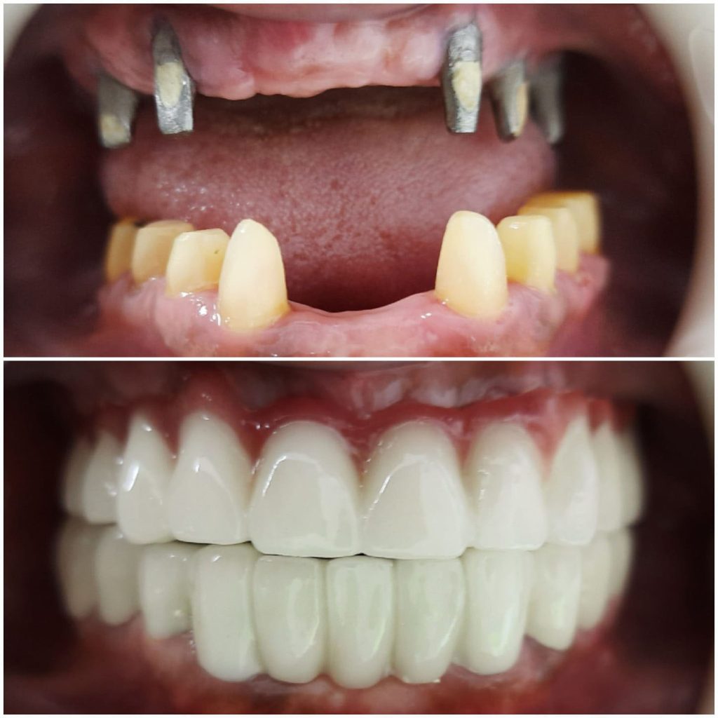 All on 4 Dental Implants Procedure in Turkey 3 All on 4 Dental implants