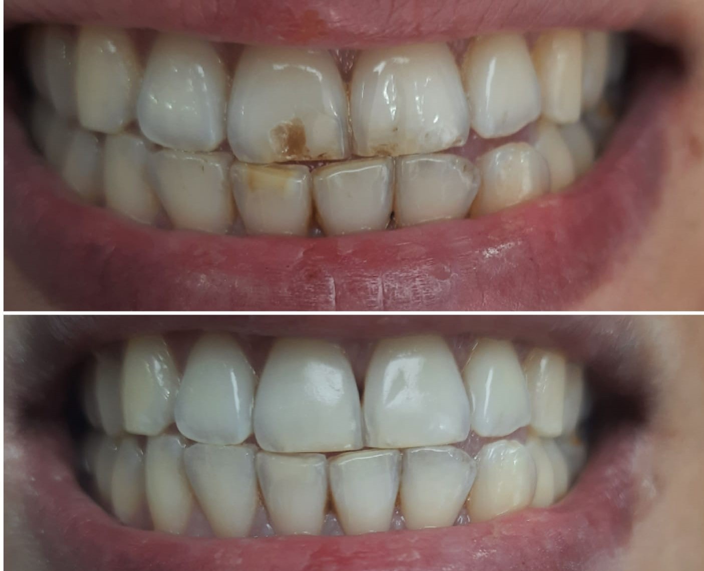 Dental Veneers Before - After 1