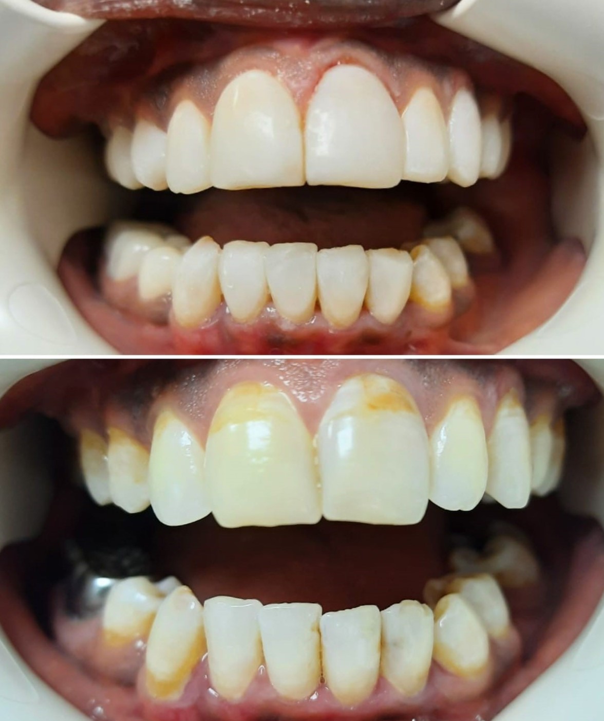 Белење на заби пред - после 1