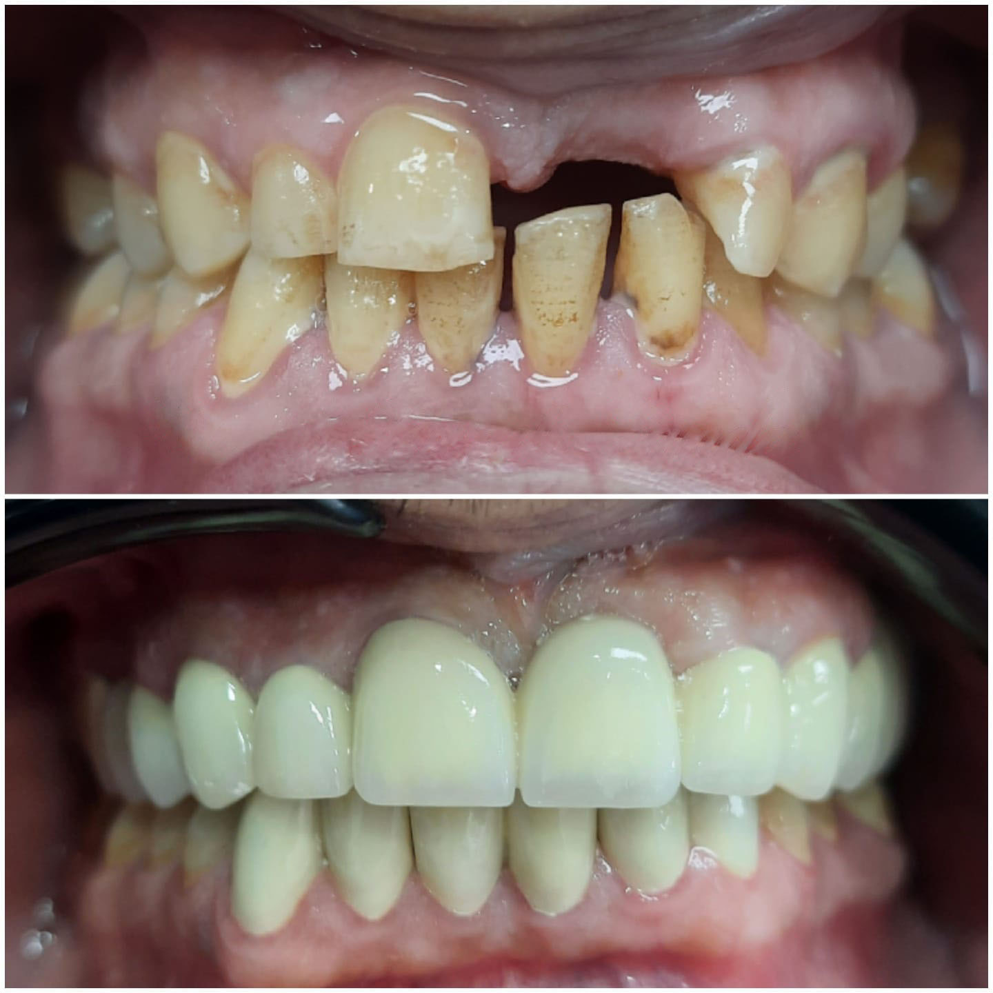 Implant fiaclaireachd roimhe - às deidh 2