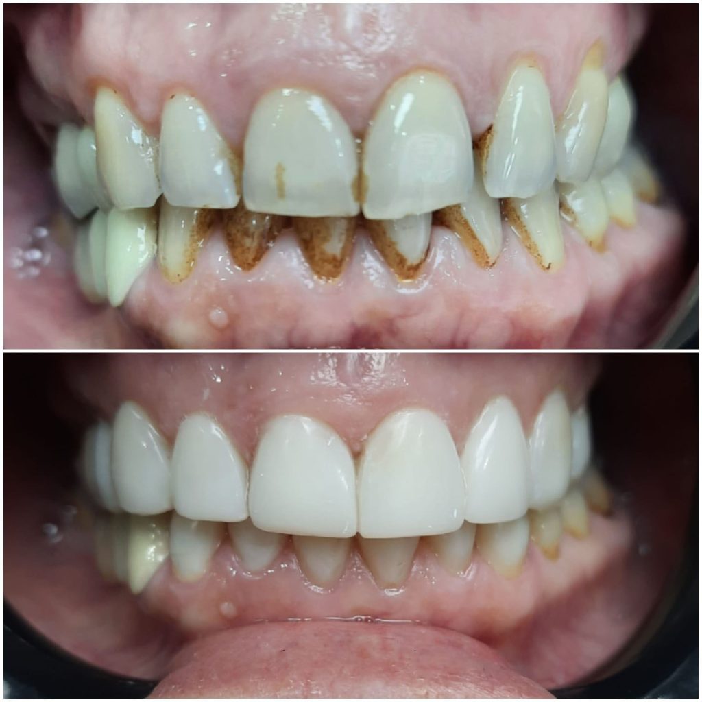 Teeth Whitening Before - After 2