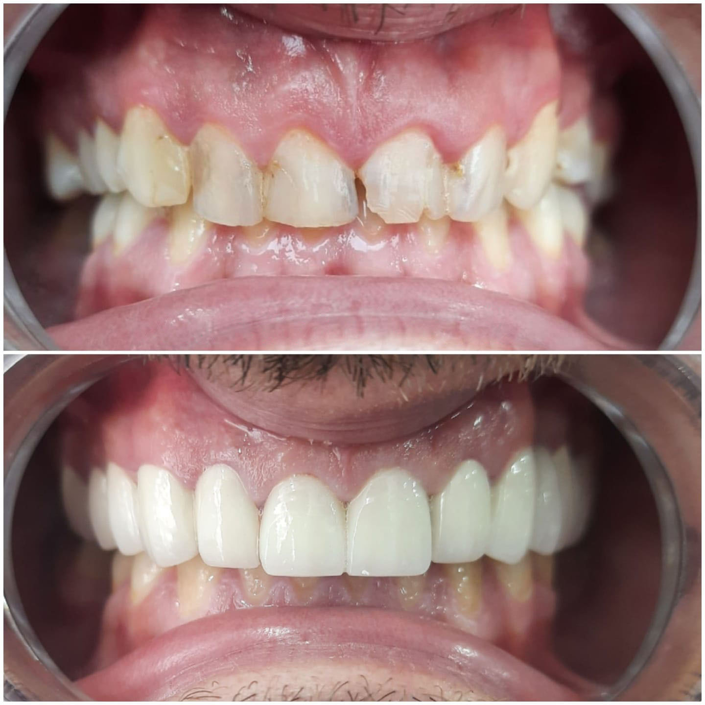 IiVeneers zamazinyo Ngaphambili-Emva kwe-2