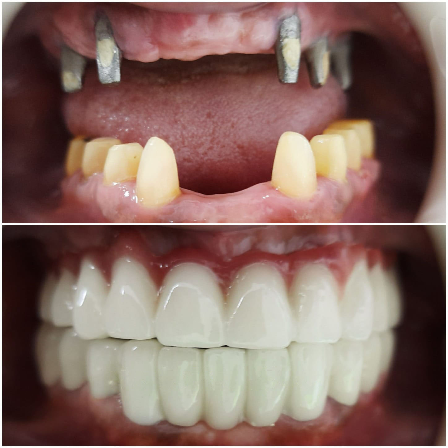 Dental Implant Before After