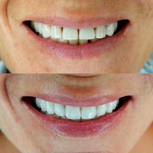 Hollywood Smile Before - After 3