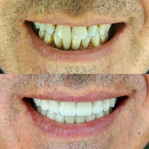 Hollywood Smile Before - After 1