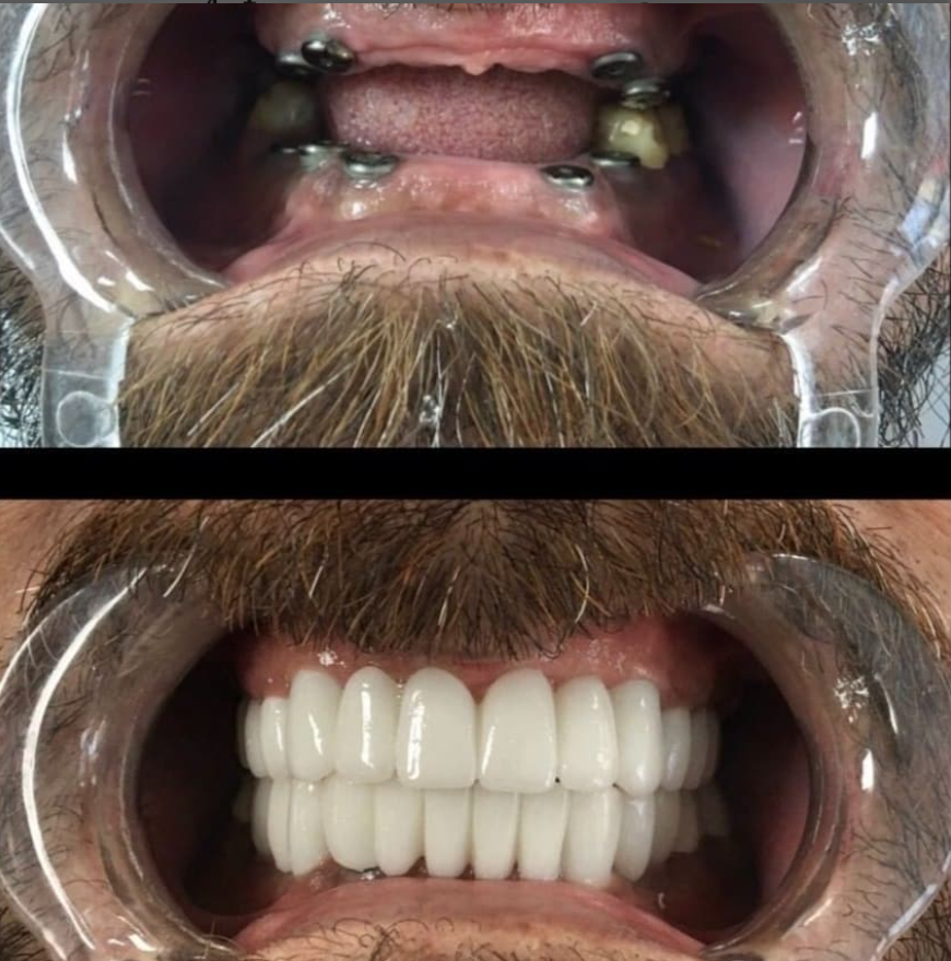 Dental Implant Before - After 3