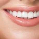 Hollywood Smile Kits