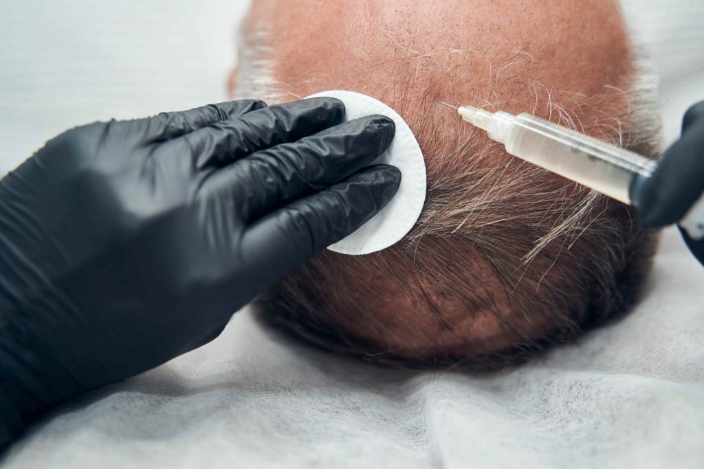 Transplantasi rambut terbaik Turki