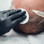 Turkey best hair transplant