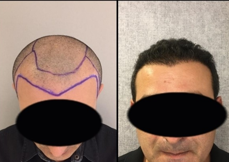 Hair Transplant Before After  3