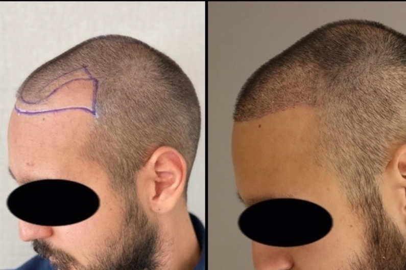 Hair Transplant Before After  5