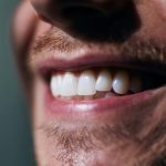 Kusadasi Teeth Whitening