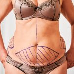 woman-body-with-marks-for-plastic-surgery-2022-05-28-10-48-03-utc-min