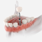 implantes dentales en montenegro