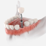 dental implants in montenegro