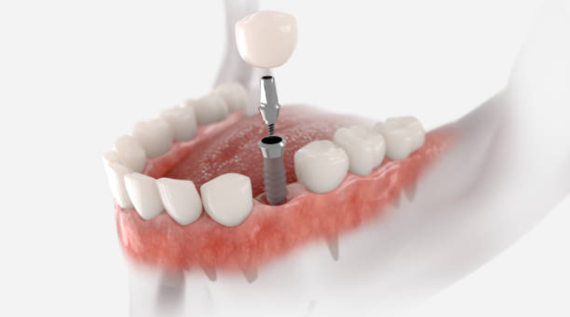 implants dentals a montenegro