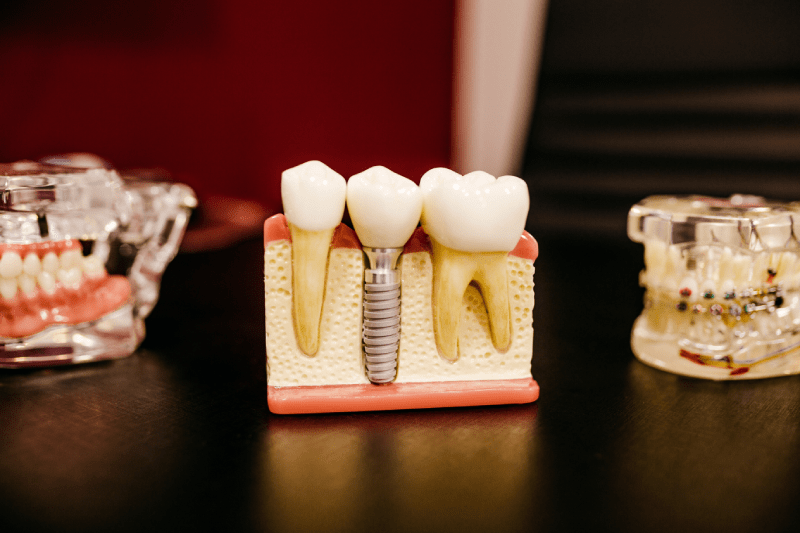 Zubný implantát