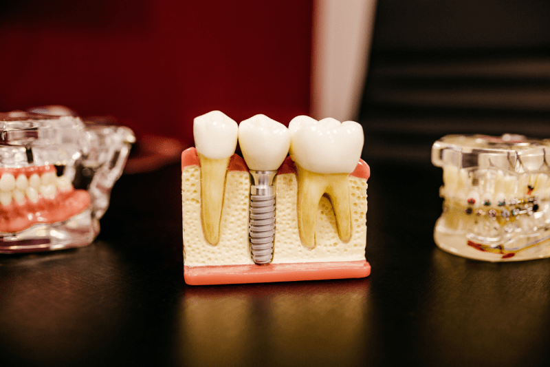 Dental Implant 