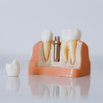 hambaimplantaadid-kalkuni-kalkuni-hambaimplantaadi-protsess-implantaadi-brändid-turkiye