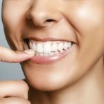 Dental-Veneers-Porzellan-Veneers-in-der-Türkei-Composite-Harz-Veneer-Zähne-Farbe-Schottland-Veneer-Dental-Tourismus-Türkei