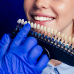 dental-veneers-porselin-veneers-in-turki-composite-resin-veneer-tooth-color-veneer-color