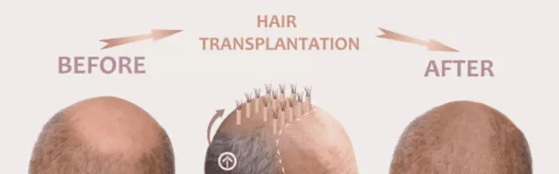What Are the Price of a Hair Transplant in Serbia and the Best Hair Transplant Clinics 11 Background 25 5