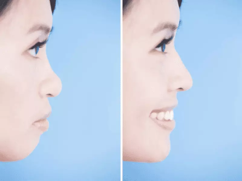 How Is Nose Surgery ( Rhinoplasty ) Or ‘’Nose Job’’ in Montenegro 4 Background 28 3
