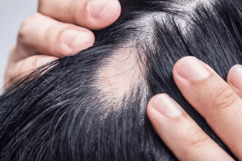 What Is Women Hair Transplant in Turkey? Causes, Remedies, and Price 5 Background 37 1