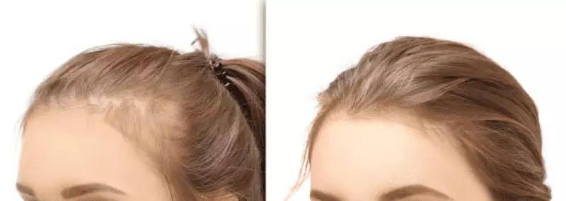 What Is Women Hair Transplant in Turkey? Causes, Remedies, and Price 17 Background 39 2