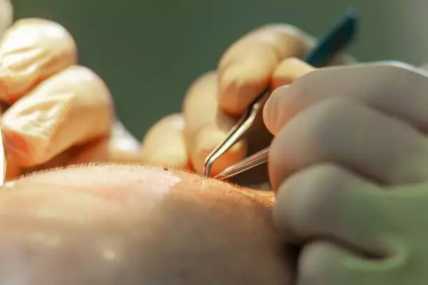 What Is Women Hair Transplant in Turkey? Causes, Remedies, and Price 11 istockphoto 1154596856 612x612 1