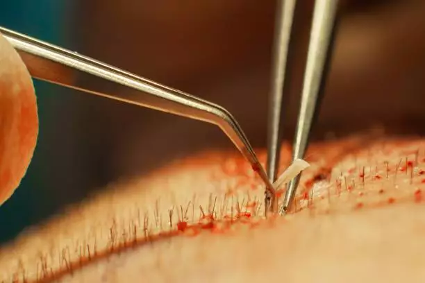 What Are the Price of a Hair Transplant in Serbia and the Best Hair Transplant Clinics 10 istockphoto 1162897913 612x612 1