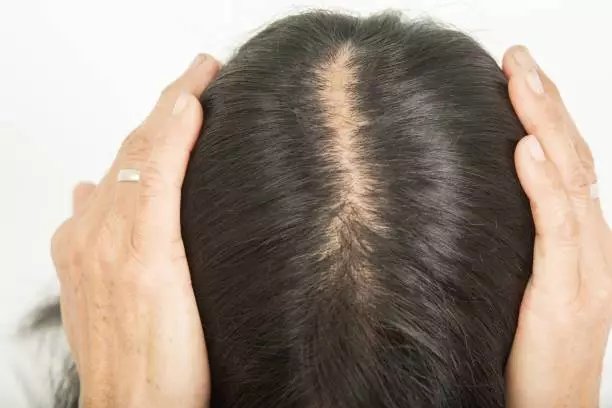 What Is Women Hair Transplant in Turkey? Causes, Remedies, and Price 7 istockphoto 1177149478 612x612 1