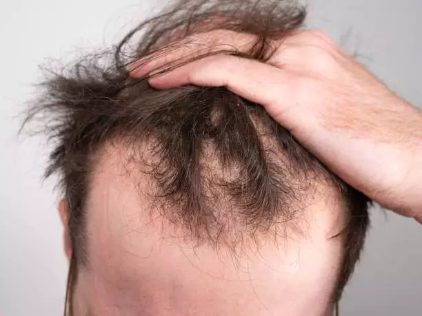 What Are the Price of a Hair Transplant in Serbia and the Best Hair Transplant Clinics 4 istockphoto 1357275497 612x612 1