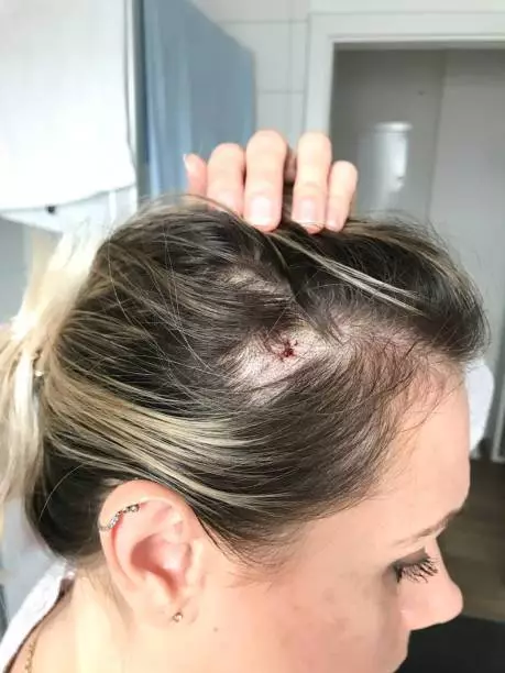 What Is Women Hair Transplant in Turkey? Causes, Remedies, and Price 6 istockphoto 1427960410 612x612 1