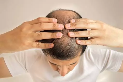 What Are the Price of a Hair Transplant in Serbia and the Best Hair Transplant Clinics 5 istockphoto 501619924 170667a