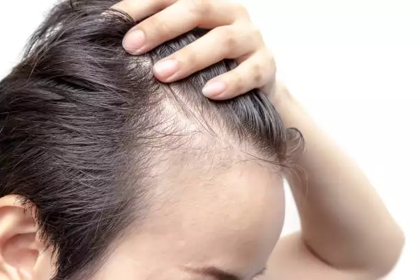 Hair Transplant Cost in Bulgaria 5 istockphoto 687993882 612x612 1