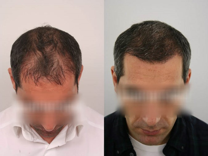 Hair Transplant Prices in Turkey – Best Price Guaranteed 4 sac 3 Kopya