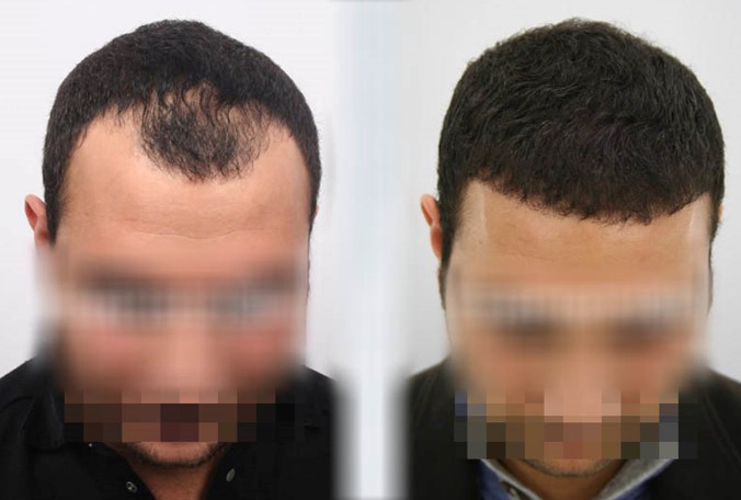 How Long Does It Take to See Results After Hair Transplant Treatment? 4 sac 5