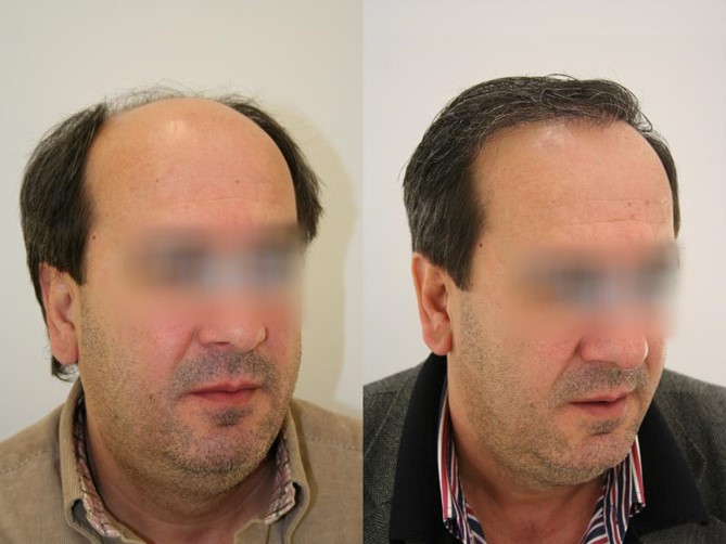 How Long Does It Take to See Results After Hair Transplant Treatment? 2 sac2 Kopya
