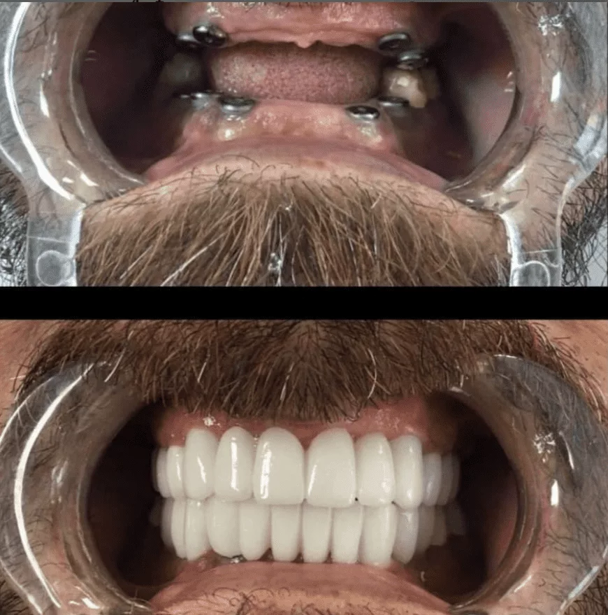 Revisións de implantes dentales