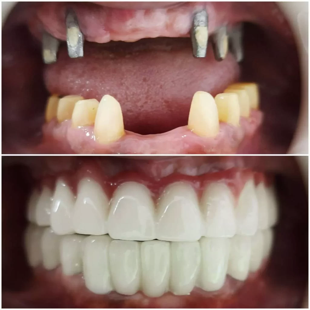 comentários sobre implantes dentários