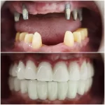 mga pagsusi sa dental implant
