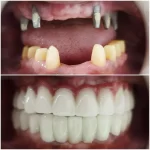 ulasan implan dental