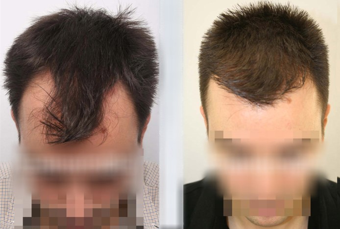 turkey hair transplant before after photo