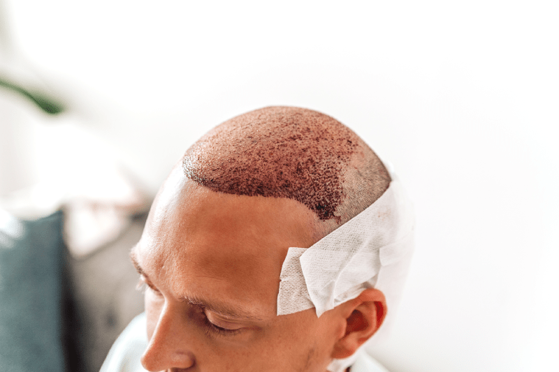 hair transplant hungary cost hair loss treatment budapest
