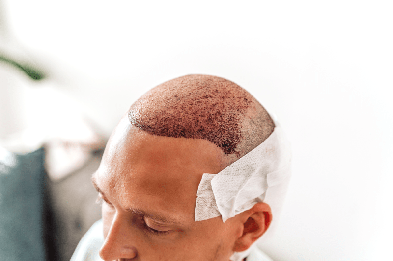 Hair Transplants in Hungary: How Much Are Hair Transplants in Hungary? 5 hair transplant hungary cost hair loss treatment budapest