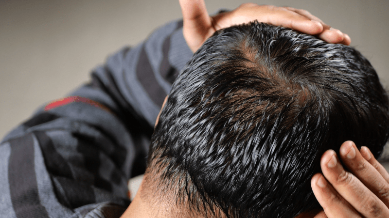 زراعة الشعر في المجر، زراعة الشعر في تركيا